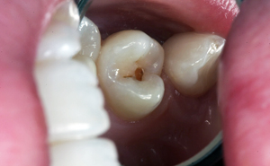 Fillings - Before - Orgreave Dental