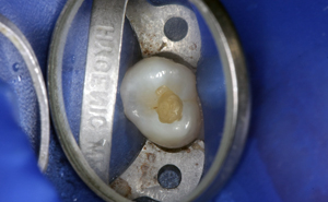 Fillings - During - Orgreave Dental