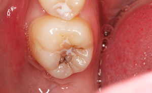 Tooth Fillings - Before - Orgreave Dental