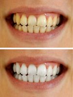 Tooth Whitening at Orgreave Dental in Sheffield