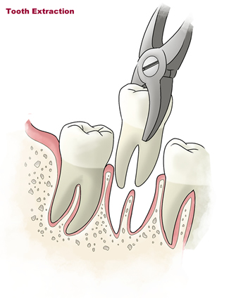 Orgreave Dental Tooth Extractions