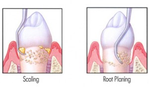 Root Planing - Orgreave Dental
