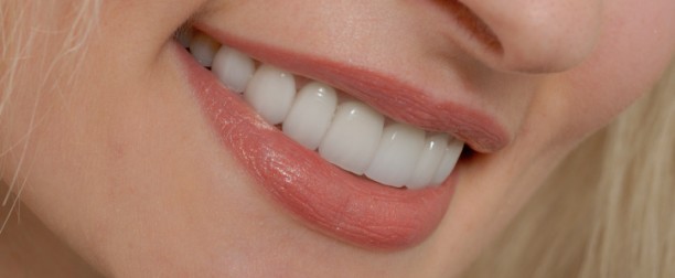 Veneers