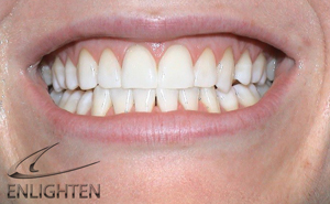 Enlighten Tooth Whitening - Orgreave Dental Surgery Sheffield