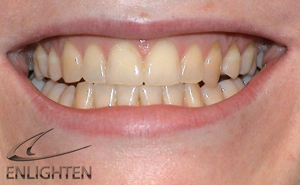 Enlighten Tooth Whitening - Orgreave Dental Surgery Sheffield