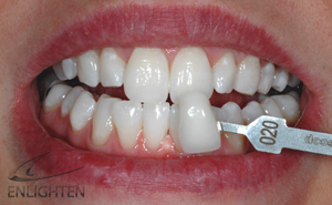Enlighten - After - Ogreave Dental
