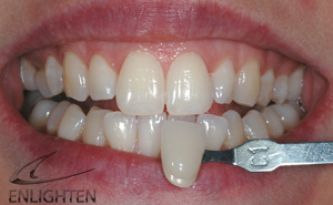 Enlighten Tooth Whitening - Orgreave Dental Surgery Sheffield